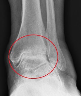 Neutral Ankle OA