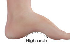 Cavus Foot Deformity