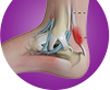 Achilles Tendon Disorders