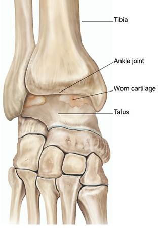 Ankle Arthritis OA Illustration