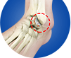 Ankle Arthritis