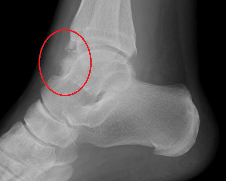 Impingement ankle xray