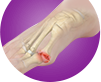Big Toe Arthritis