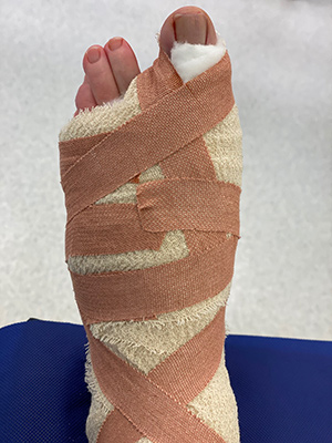 Bunion Bandage