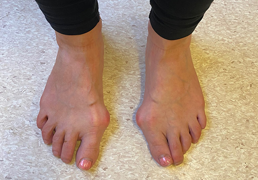 Bunion Clinical Picture