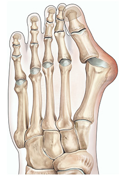 Bunion Illustration