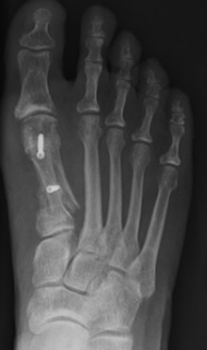 Bunion Post Op X-ray