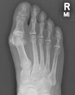 Bunion Pre Op X-ray