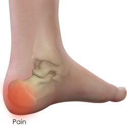 Heel Pain