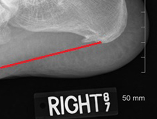 Heel Spur X-Ray