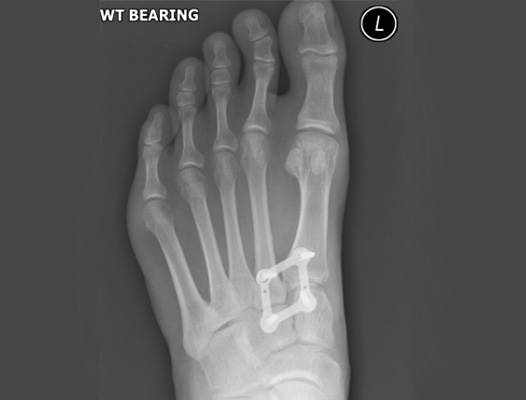 Lisfranc Fixation