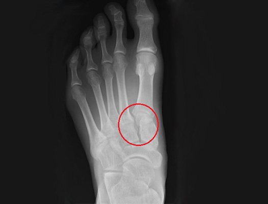 Lisfranc Injury