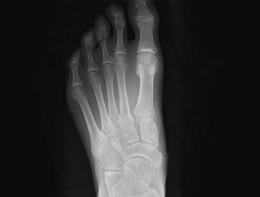 Lisfranc Injury