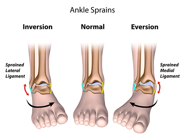 Mechanism of Injury