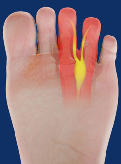 Morton’s Neuroma