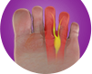 Morton's Neuroma