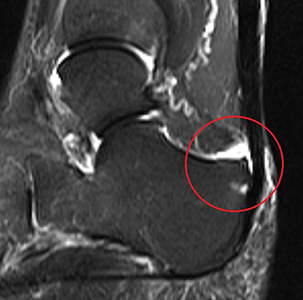 MRI OF HAGLUNDS