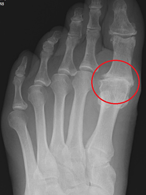 XRAY OF MTPJ OA SEVERE