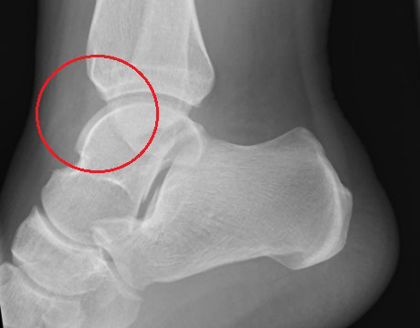 Nornal ankle xray