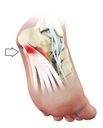 Plantar Fasciitis