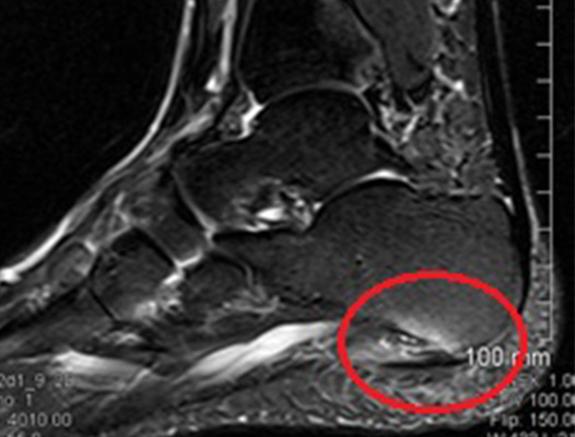 Plantar MRI