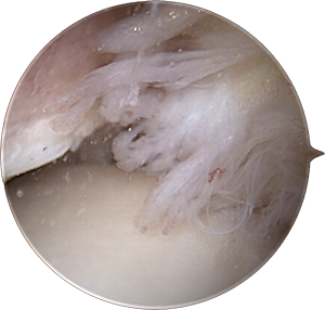 Ankle scope impingement