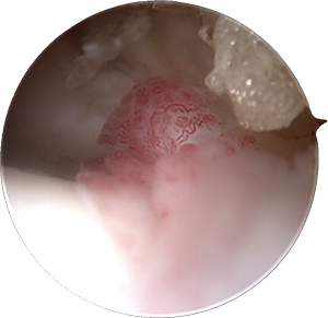 Ankle scope synovitis