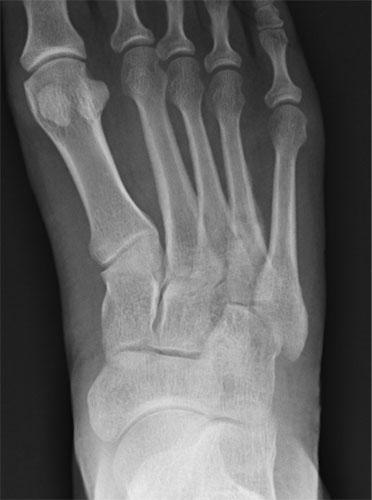 Stress Fractures
