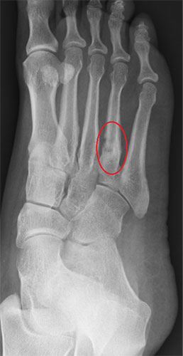 Stress Fractures