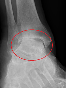 Valgus Ankle OA