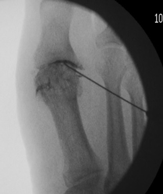 XRAY OF FOOT INJECTION