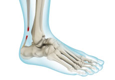 Achilles Tendon Rupture