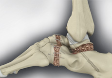 Ankle Arthrodesis