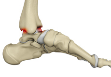 Anterior Ankle Impingement