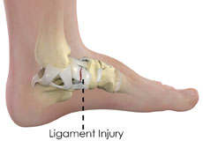 Ankle Ligament Injury