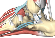 Ankle Ligament Reconstruction