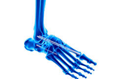 Charcot Reconstruction