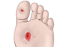 Diabetic Foot Conditions