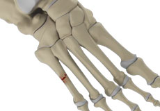 Fifth Metatarsal Fractures