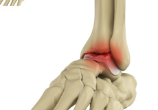 Foot and Ankle Osteotomy