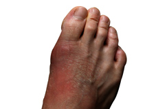 Foot Infections