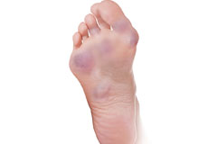 Ankle Rheumatoid Arthritis