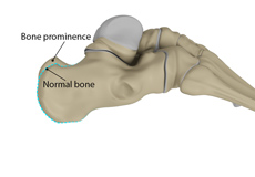 Haglunds Deformity