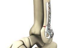 Internal and External Fixation of Foot and Ankle Fractures