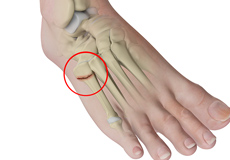 Metatarsal and Phalangeal (Forefoot) Fractures