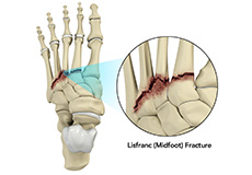 Midfoot Arthritis