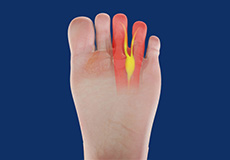 Morton's Neuroma