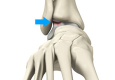 Osteochondral Injuries of the Ankle