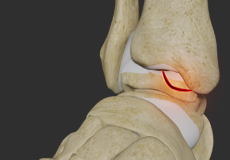 Osteochondral Lesions of the Ankle