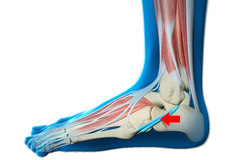 Peroneal Tendon Dislocation